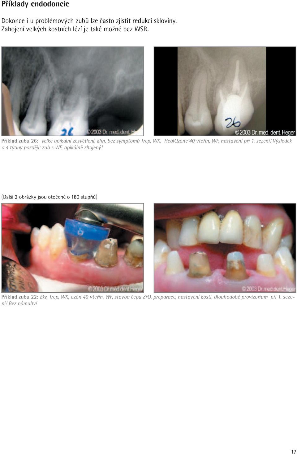 bez symptomů Trep, WK, HealOzone 40 vteřin, WF, nastavení při 1. sezení! Výsledek o 4 týdny později: zub s WF, apikálně zhojený!
