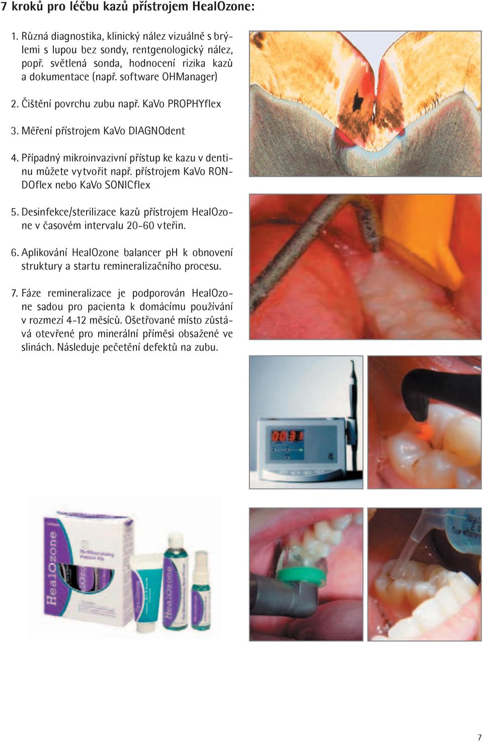 Případný mikroinvazivní přístup ke kazu v dentinu můžete vytvořit např. přístrojem KaVo RON- DOfle nebo KaVo SONICfle 5.