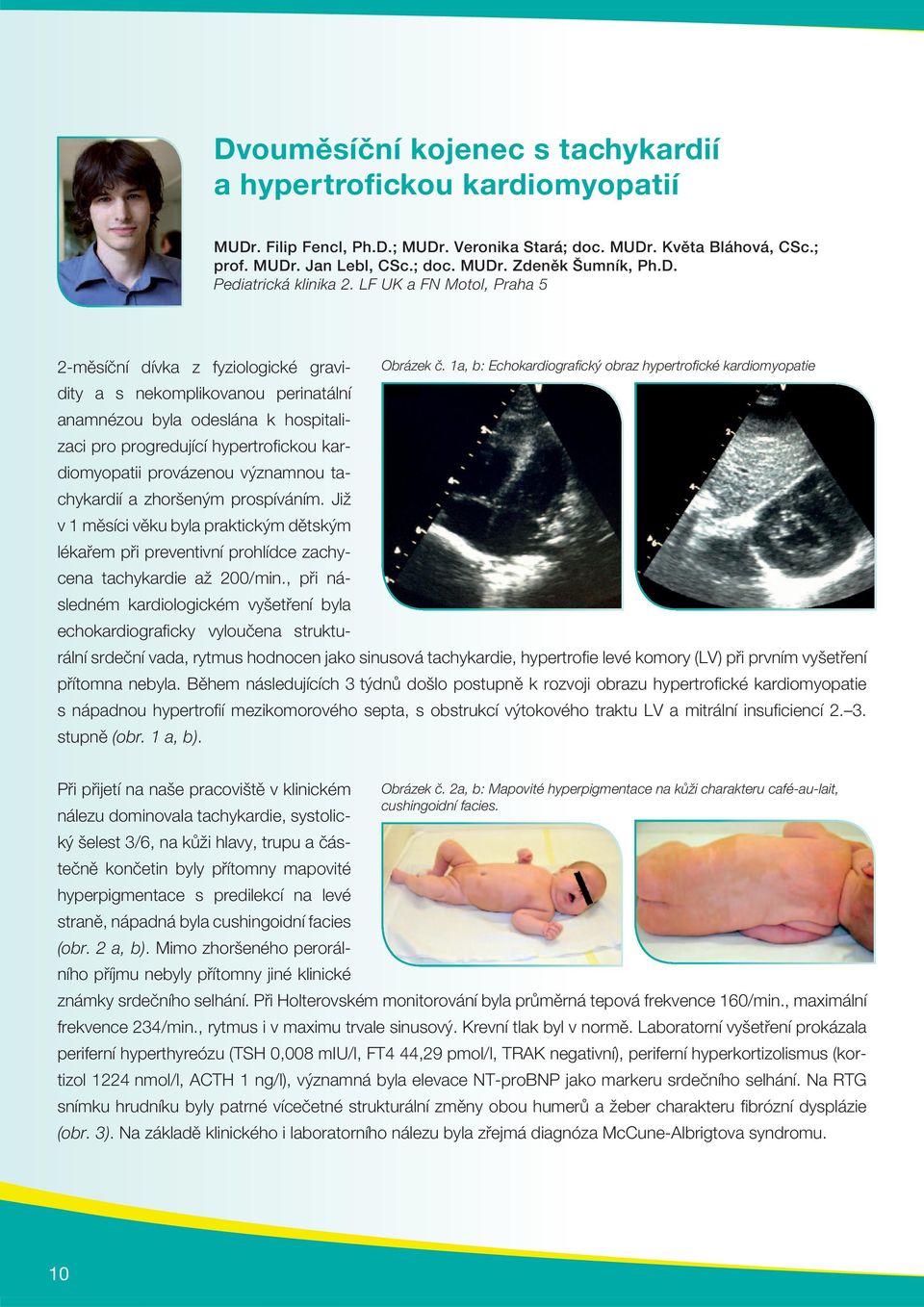 1a, b: Echokardiografi cký obraz hypertrofi cké kardiomyopatie anamnézou byla odeslána k hospitalizaci pro progredující hypertrofi ckou kardiomyopatii provázenou významnou tachykardií a zhoršeným