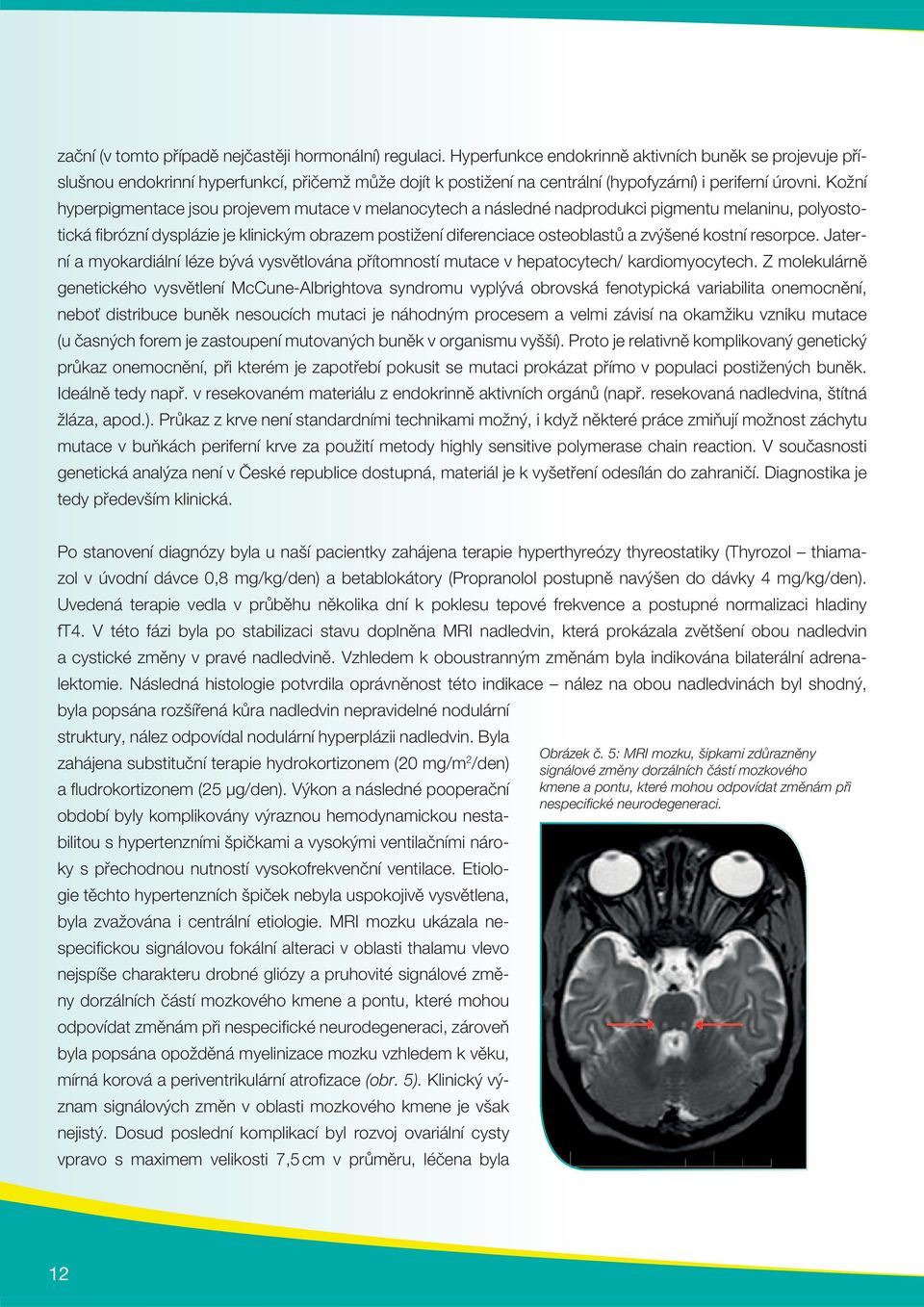 Kožní hyperpigmentace jsou projevem mutace v melanocytech a následné nadprodukci pigmentu melaninu, polyostotická fi brózní dysplázie je klinickým obrazem postižení diferenciace osteoblastů a zvýšené