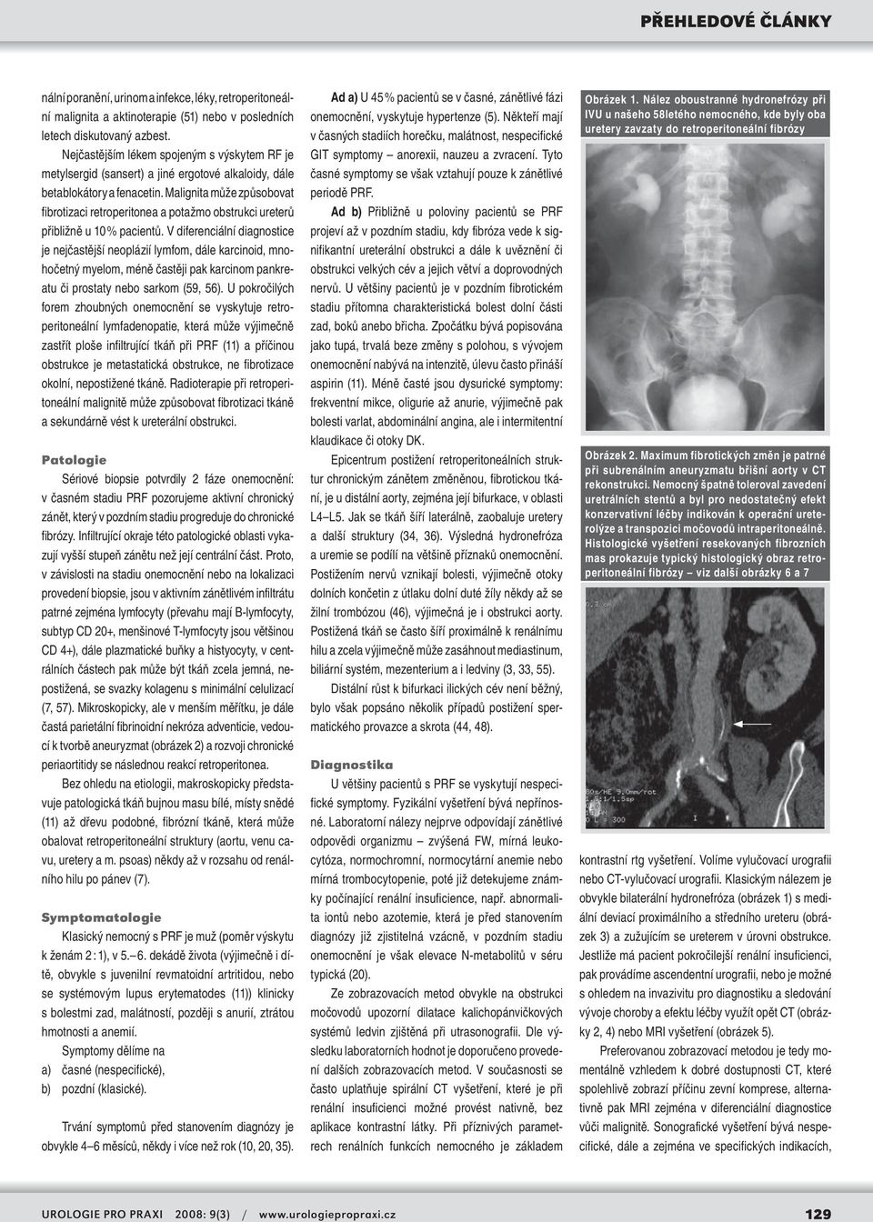 Malignita může způsobovat fibrotizaci retroperitonea a potažmo obstrukci ureterů přibližně u 10 % pacientů.