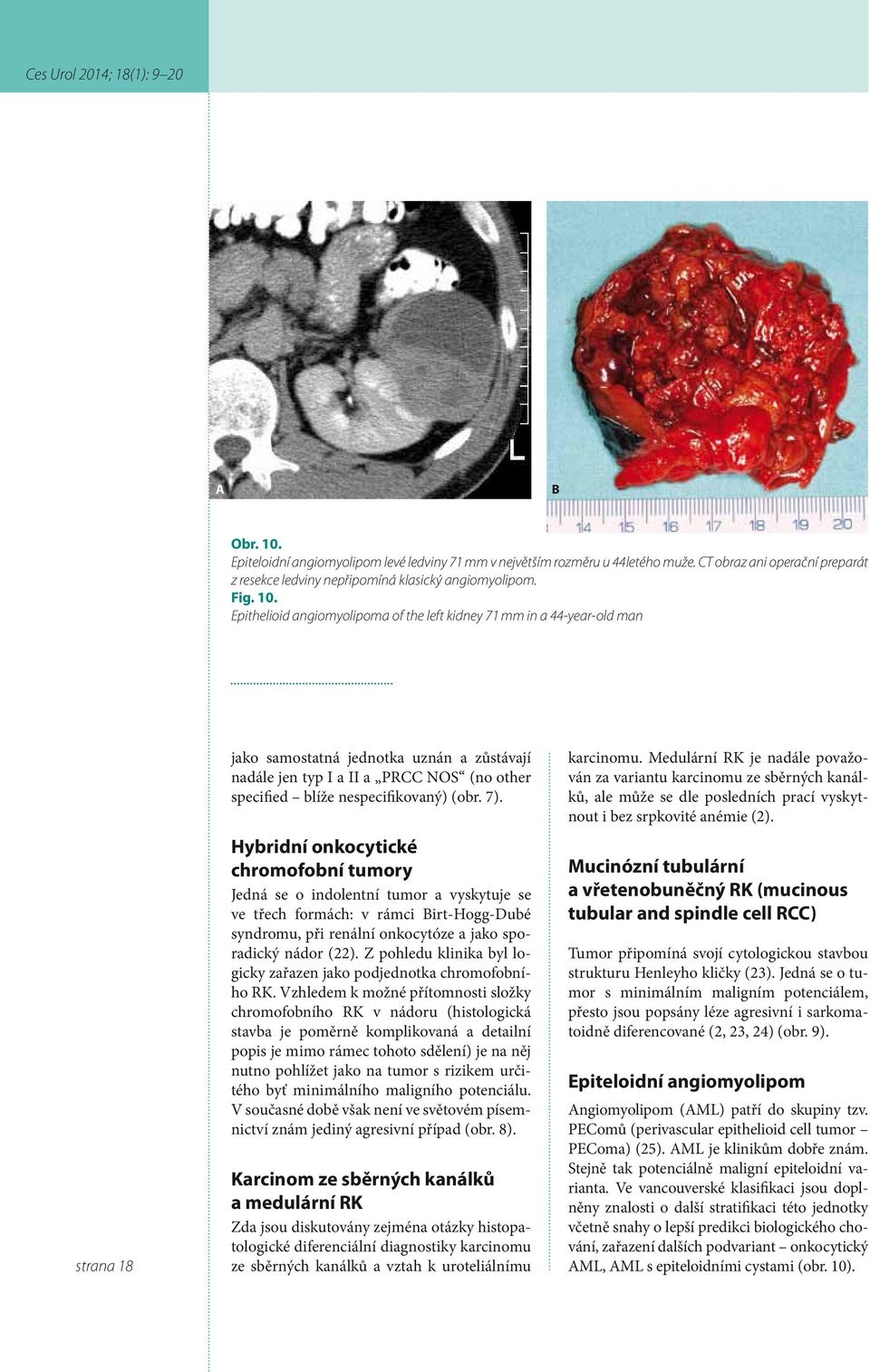 Epithelioid angiomyolipoma of the left kidney 71 mm in a 44-year-old man strana 18 jako samostatná jednotka uznán a zůstávají nadále jen typ I a II a PRCC NOS (no other specified blíže