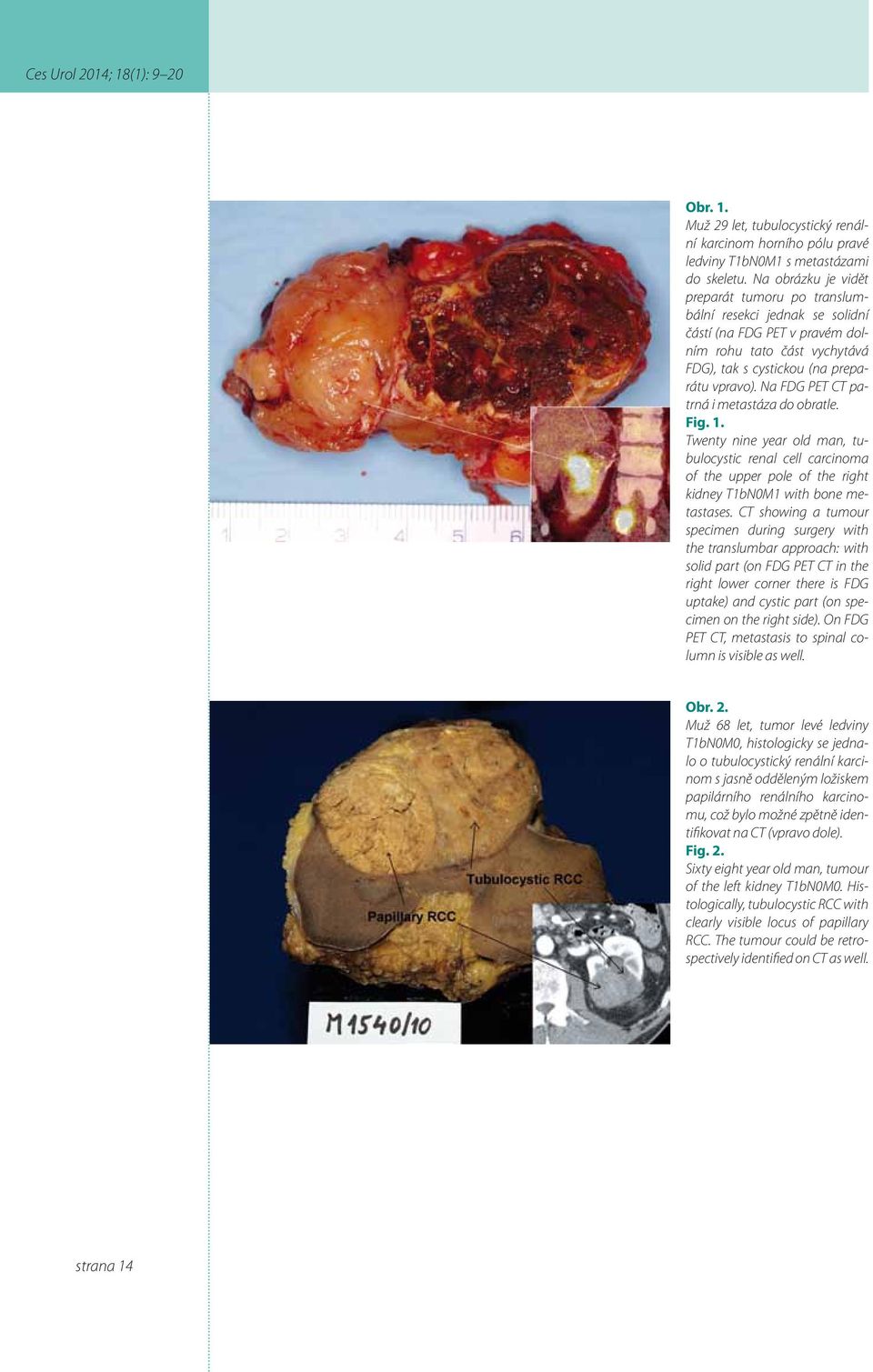 Na FDG PET CT patrná i metastáza do obratle. Fig. 1. Twenty nine year old man, tubulocystic renal cell carcinoma of the upper pole of the right kidney T1bN0M1 with bone metastases.