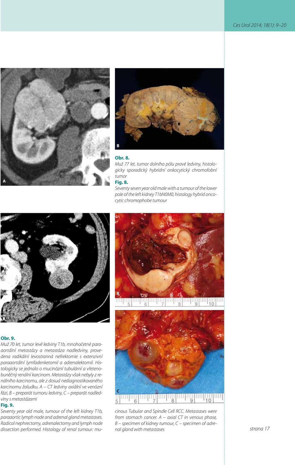 Histologicky se jednalo o mucinózní tubulární a vřetenobuněčný renální karcinom. Metastázy však nebyly z renálního karcinomu, ale z dosud nediagnostikovaného karcinomu žaludku.