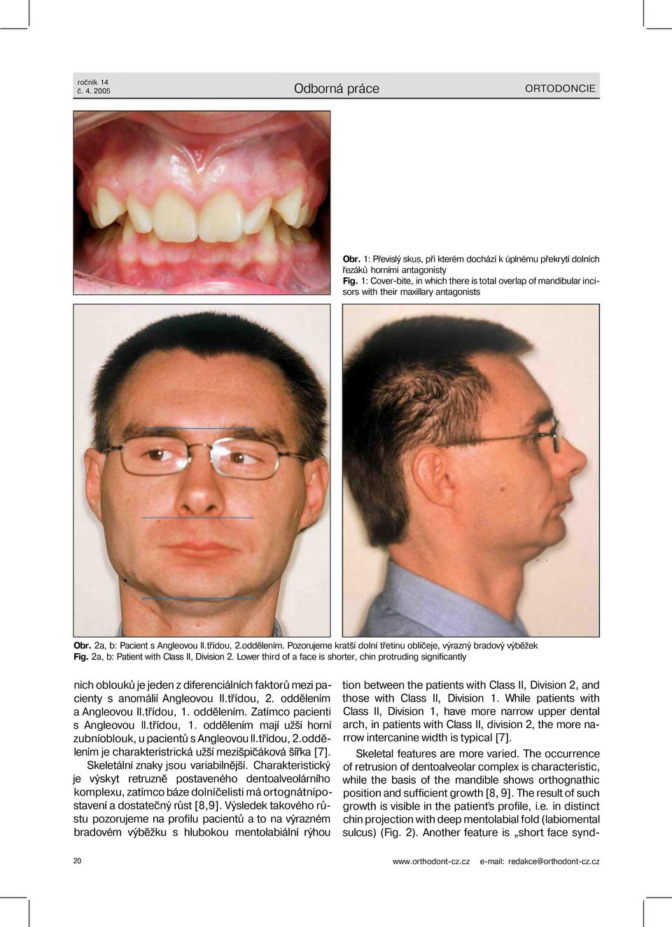 Pozorujeme kratší dolní třetinu obličeje, výrazný bradový výběžek Fig. 2a, b: Patient with Class II, Division 2.