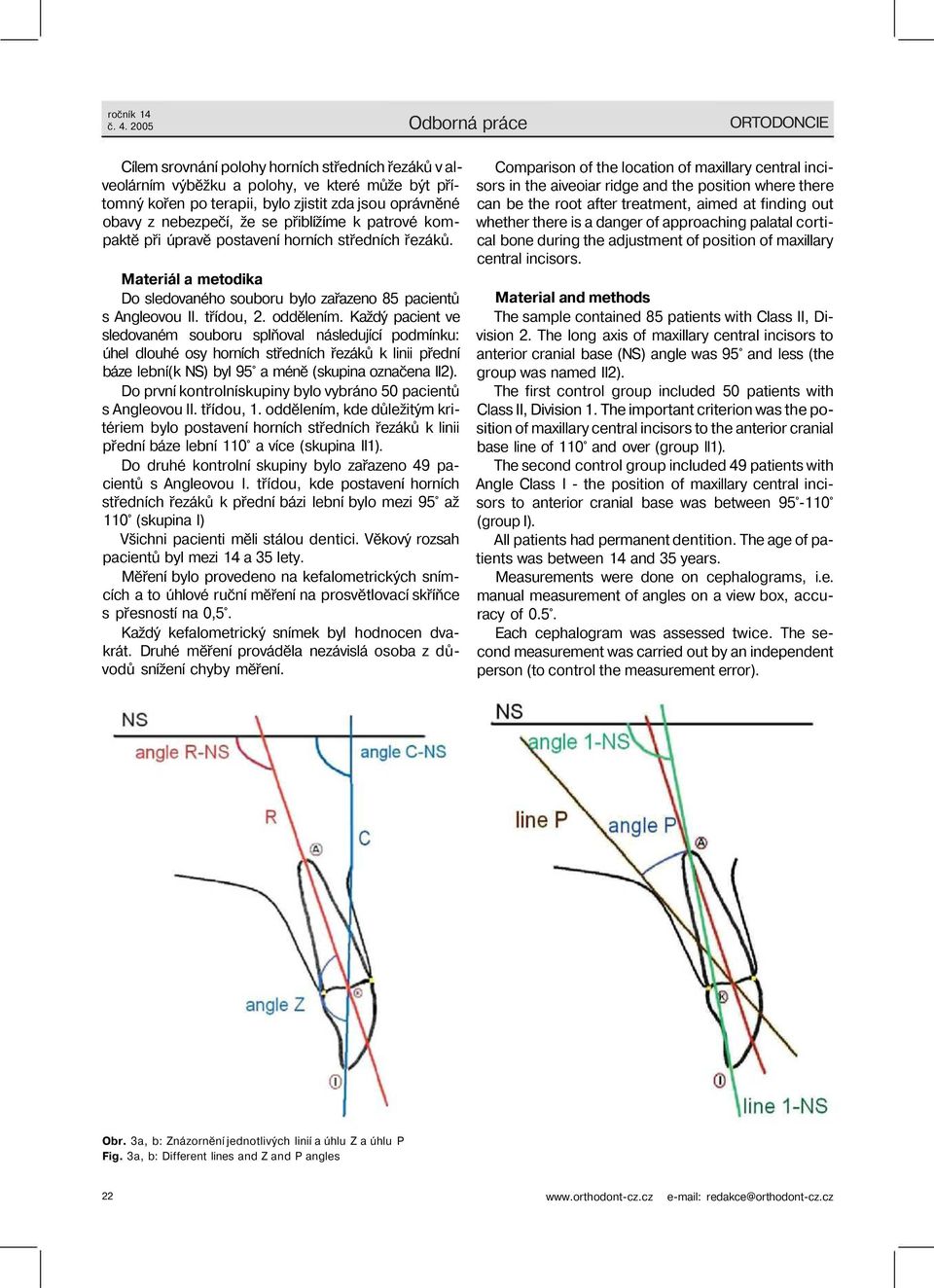 nebezpečí, že se přiblížíme k patrové kompaktě při úpravě postavení horních středních řezáků. Materiál a metodika Do sledovaného souboru bylo zařazeno 85 pacientů s Angleovou II. třídou, 2. oddělením.