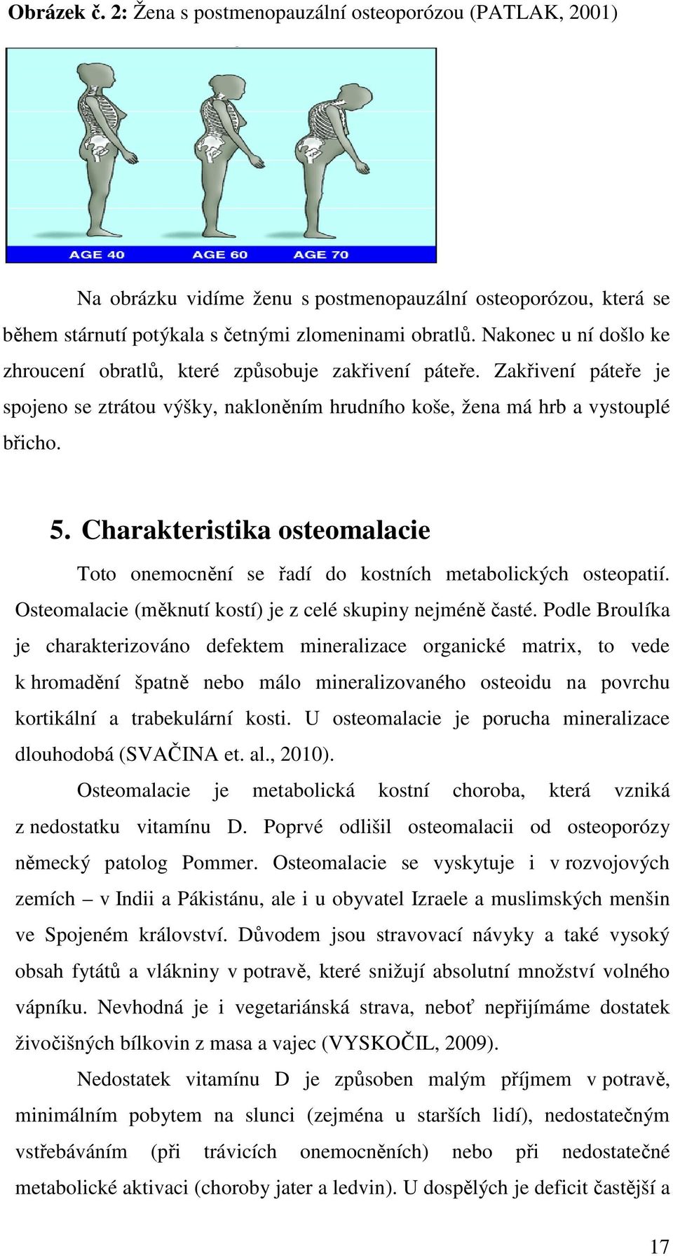 Charakteristika osteomalacie Toto onemocnění se řadí do kostních metabolických osteopatií. Osteomalacie (měknutí kostí) je z celé skupiny nejméně časté.