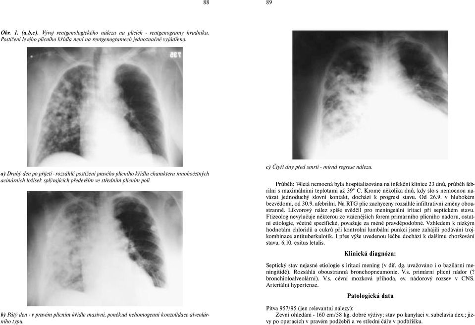 b) Pátý den - v pravém plicním křídle masivní, poněkud nehomogenní konzolidace alveolárního typu. c) Čtyři dny před smrtí - mírná regrese nálezu.