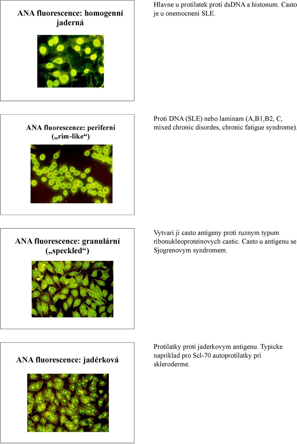 syndrome). ANA fluorescence: granulární ( speckled ) Vytvari ji casto antigeny proti ruznym typum ribonukleoproteinovych castic.