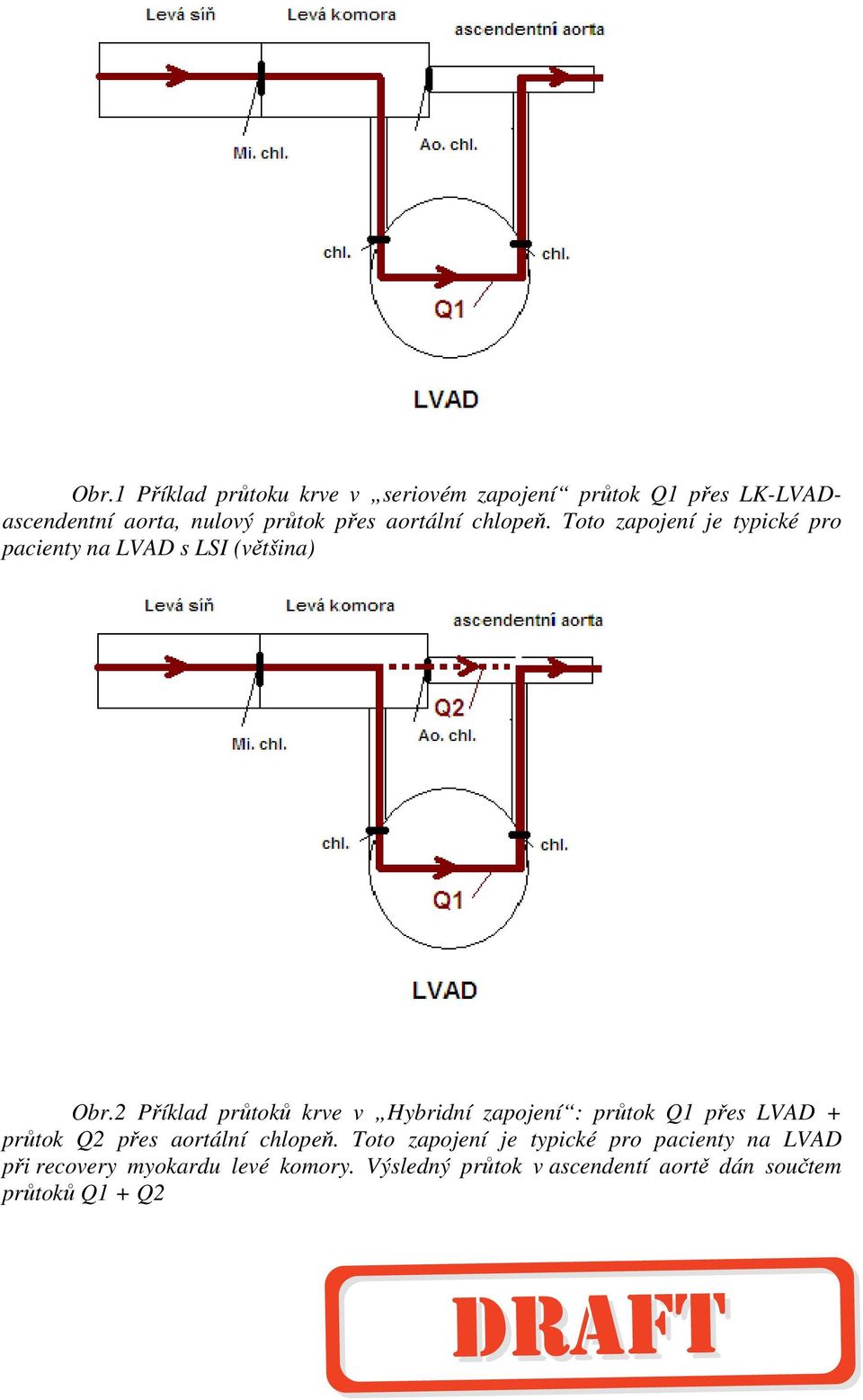 2 Příklad průtoků krve v Hybridní zapojení : průtok Q1 přes LVAD + průtok Q2 přes aortální chlopeň.