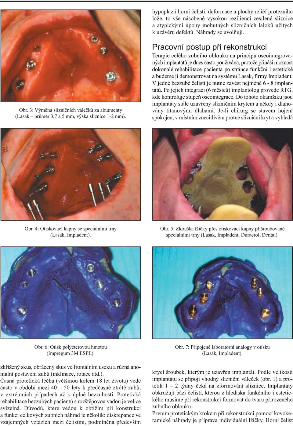 Pracovní postup při rekonstrukci Terapie celého zubního oblouku na principu oseointegrovaných implantátů je dnes často používána, protože přináší možnost dokonalé rehabilitace pacienta po stránce