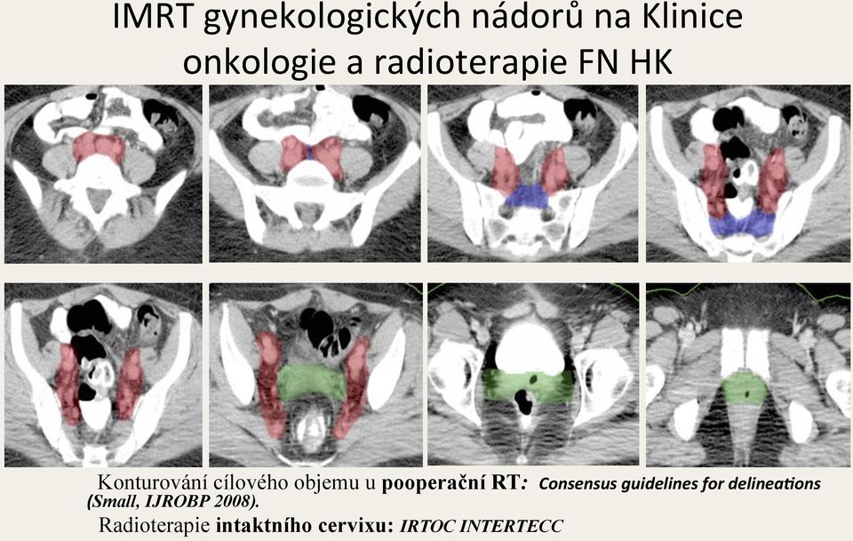 pooperační RT: Consensus guidelines for delinea/ons