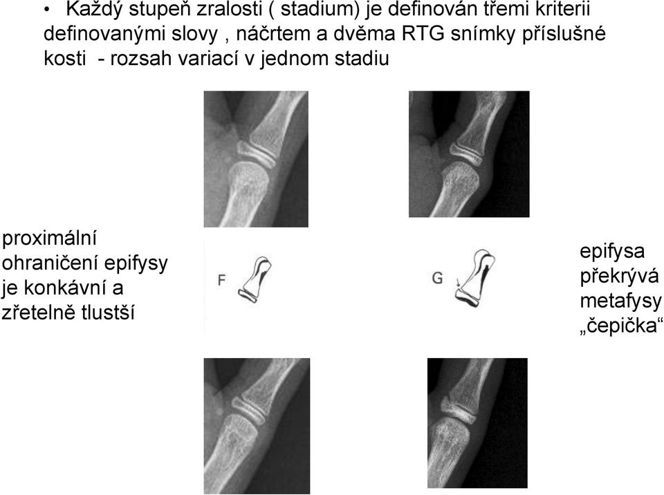 - rozsah variací v jednom stadiu proximální ohraničení epifysy