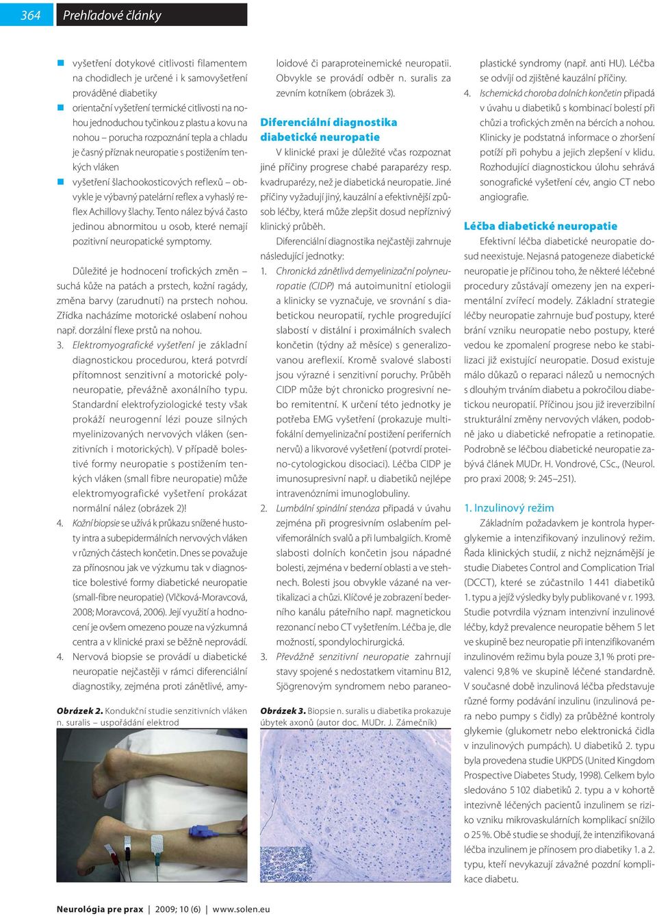 šlachy. Tento nález bývá často jedinou abnormitou u osob, které nemají pozitivní neuropatické symptomy. Obrázek 2. Kondukční studie senzitivních vláken n.