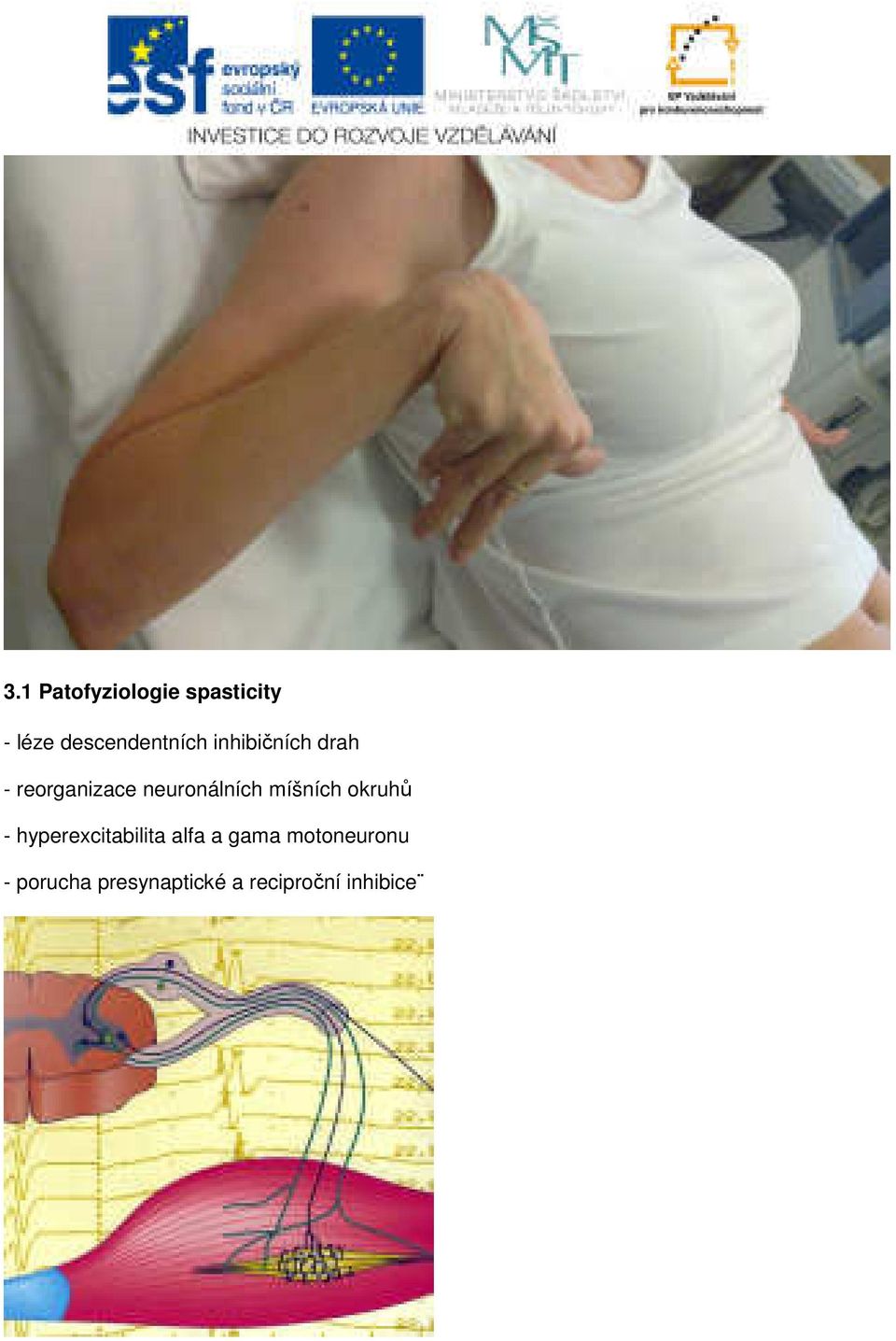 neuronálních míšních okruhů - hyperexcitabilita