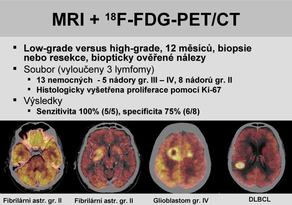 II Histologicky vyšetřena proliferace pomocí Ki-67 Výsledky Senzitivita 100% (5/5), specificita 75% (6/8) 5x vysoá