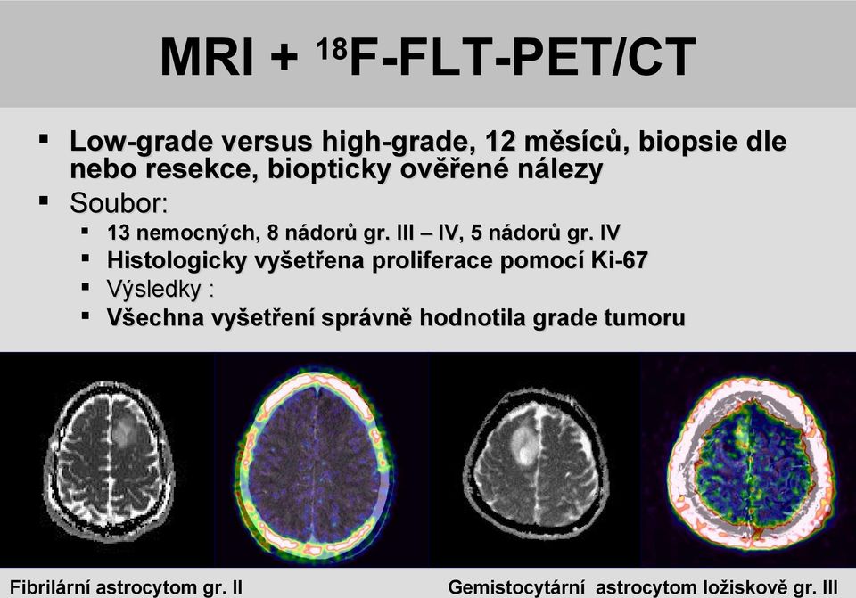 IV Histologicky vyšetřena proliferace pomocí Ki-67 Výsledky : Všechna vyšetření správně hodnotila grade tumoru