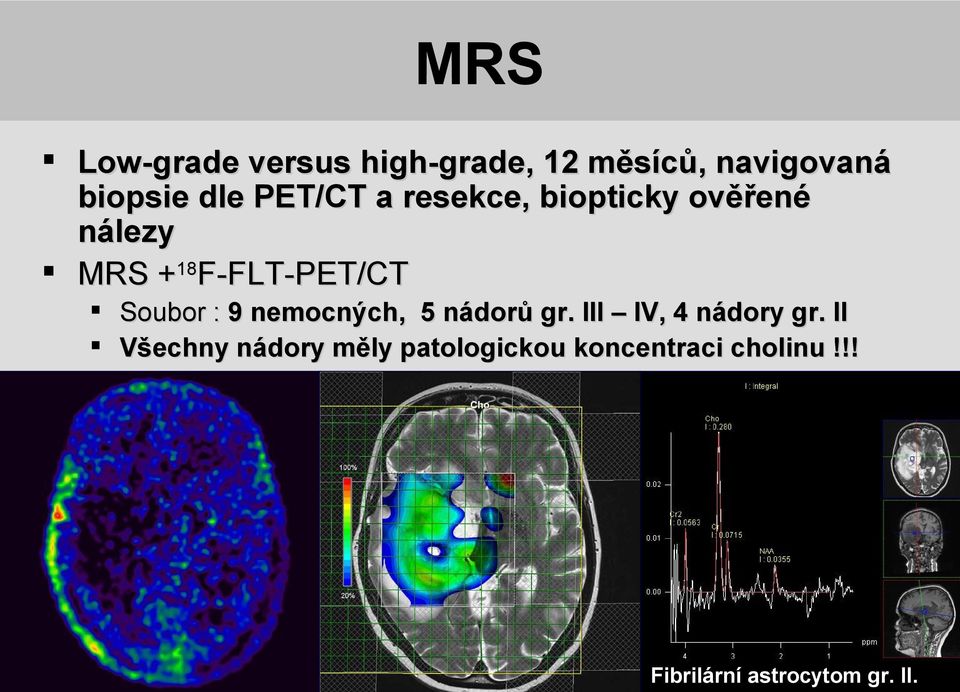 III IV, 4 nádory gr. II Všechny nádory měly patologickou koncentraci cholinu!