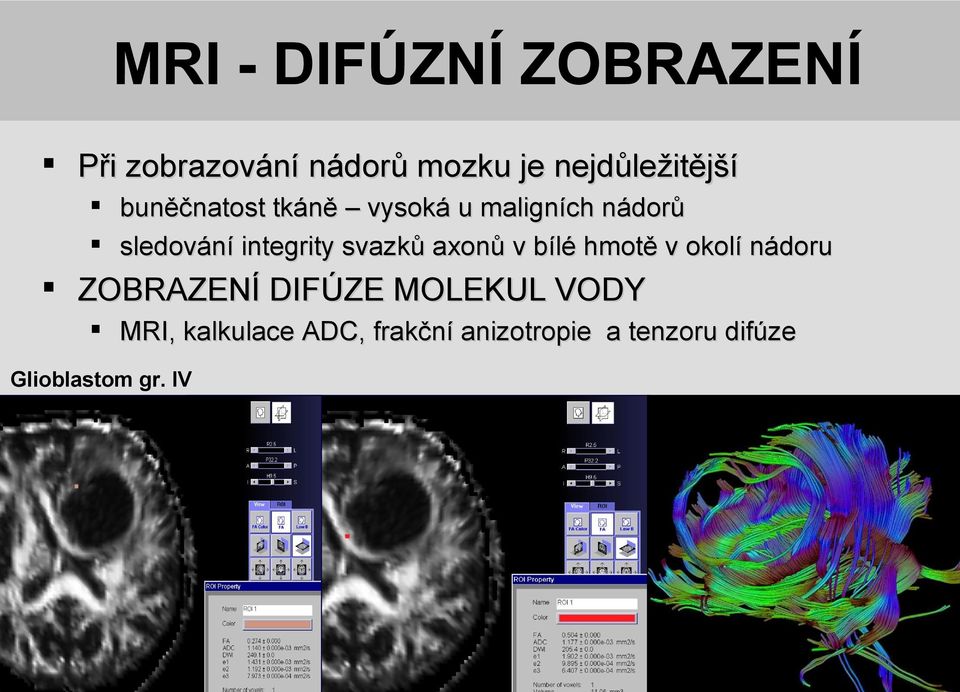 axonů v bílé hmotě v okolí nádoru ZOBRAZENÍ DIFÚZE MOLEKUL VODY MRI,