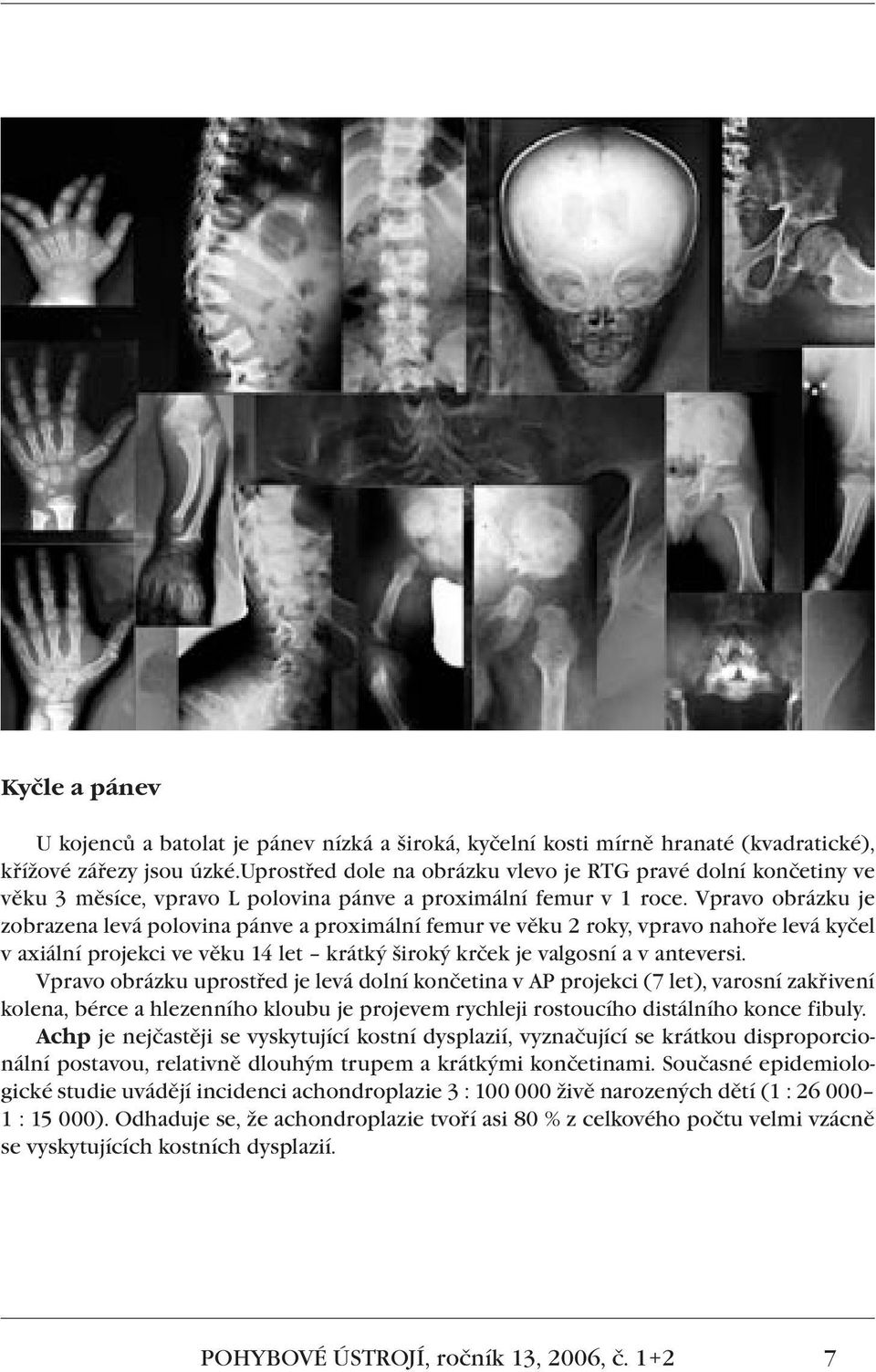 Vpravo obrázku je zobrazena levá polovina pánve a proximální femur ve věku 2 roky, vpravo nahoře levá kyčel v axiální projekci ve věku 14 let krátký široký krček je valgosní a v anteversi.