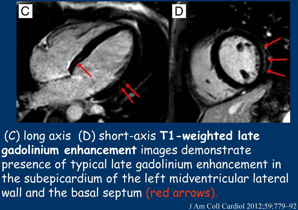 gadolinium enhancement in the subepicardium of the left