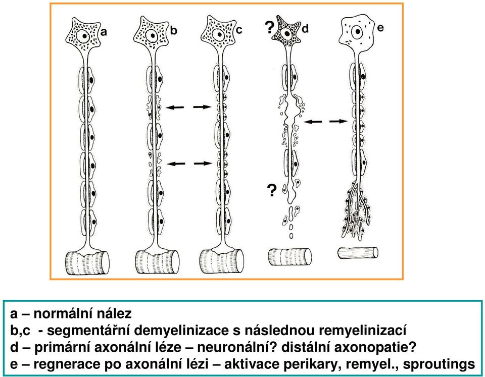 léze neuronální? distální axonopatie?