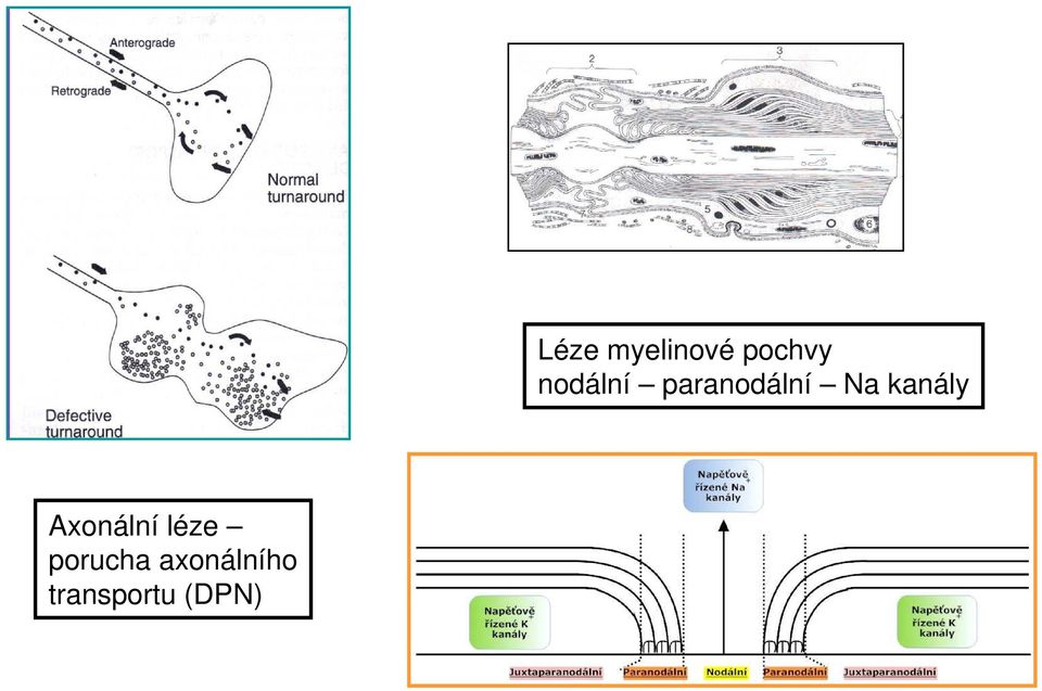 (DPN) Léze myelinové