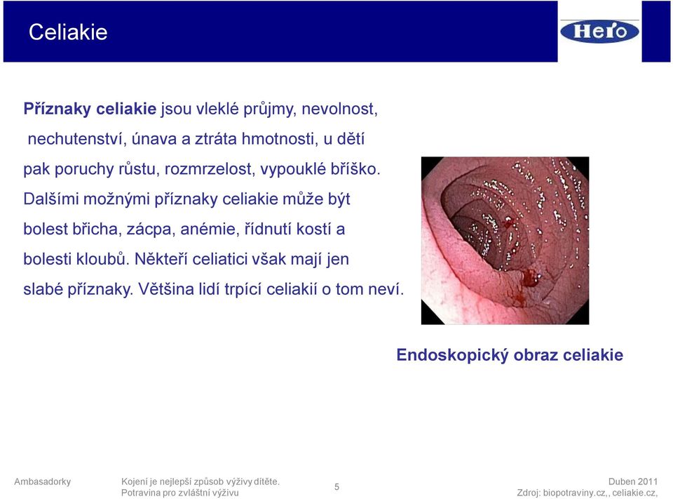 Dalšími možnými příznaky celiakie může být bolest břicha, zácpa, anémie, řídnutí kostí a