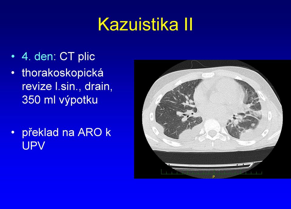 thorakoskopická revize l.