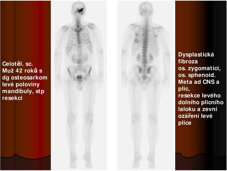 stp resekci Dysplastická fibroza os. zygomatici, os.