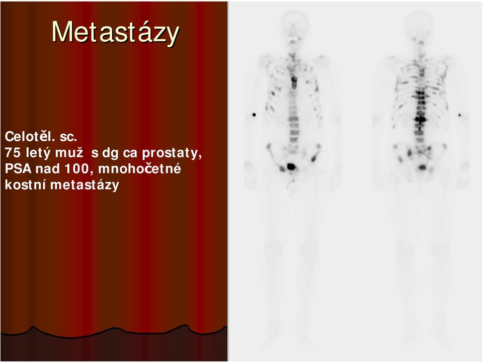 prostaty, PSA nad 100,