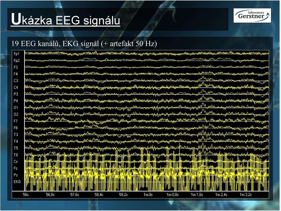 kanálů, EKG