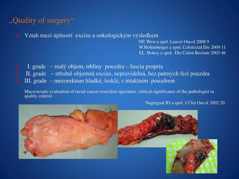 grade středně objemná excize, nepravidelná, bez patrných lézí pouzdra III.