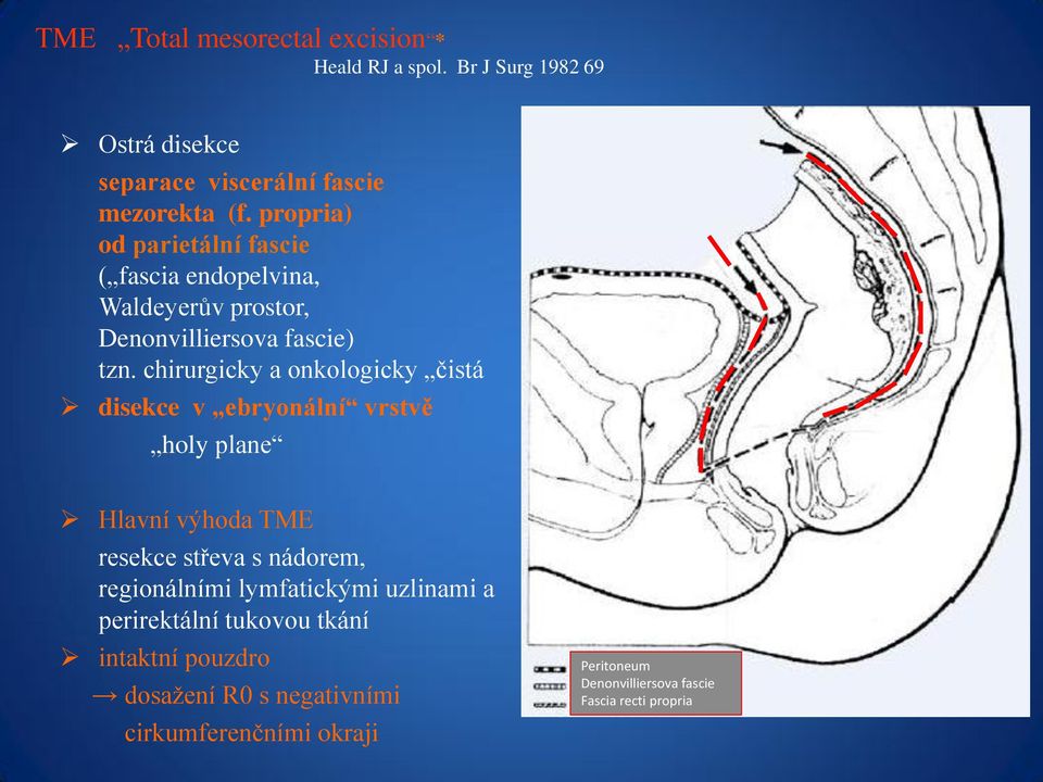 chirurgicky a onkologicky čistá disekce v ebryonální vrstvě holy plane Hlavní výhoda TME resekce střeva s nádorem, regionálními