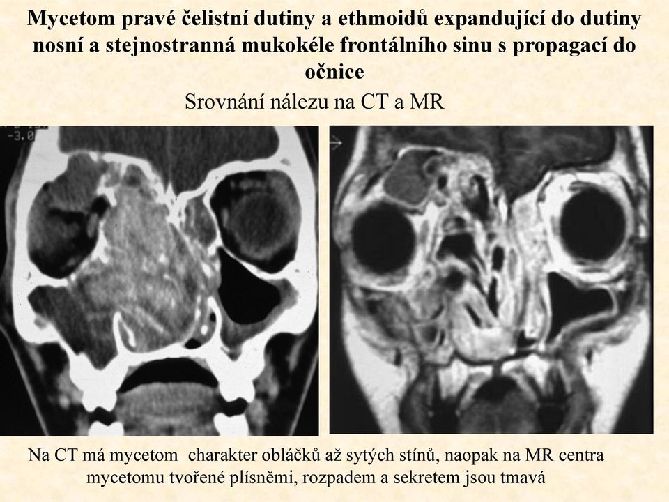 nálezu na CT a MR Na CT má mycetom charakter obláčků až sytých stínů,