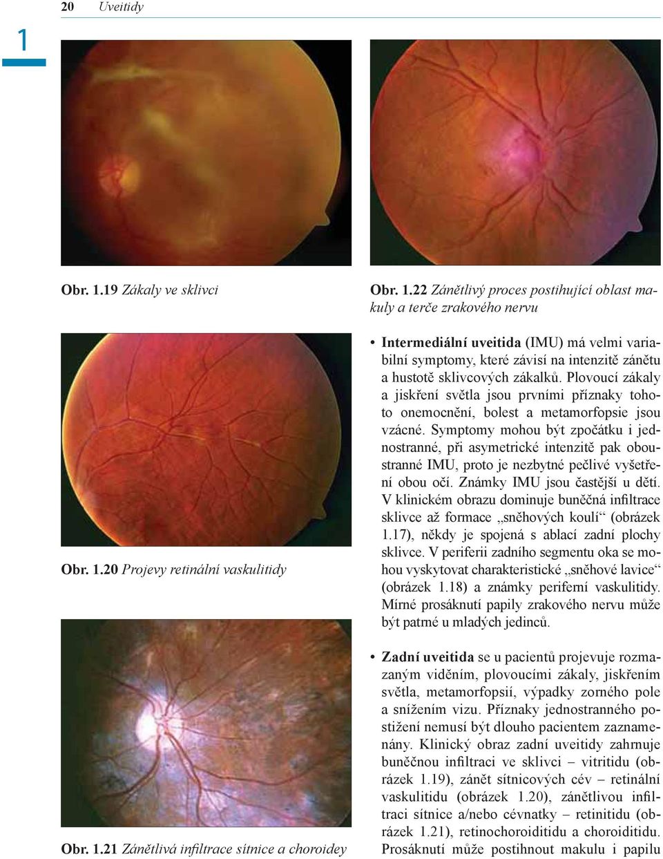 20 Projevy retinální vaskulitidy Obr. 1.