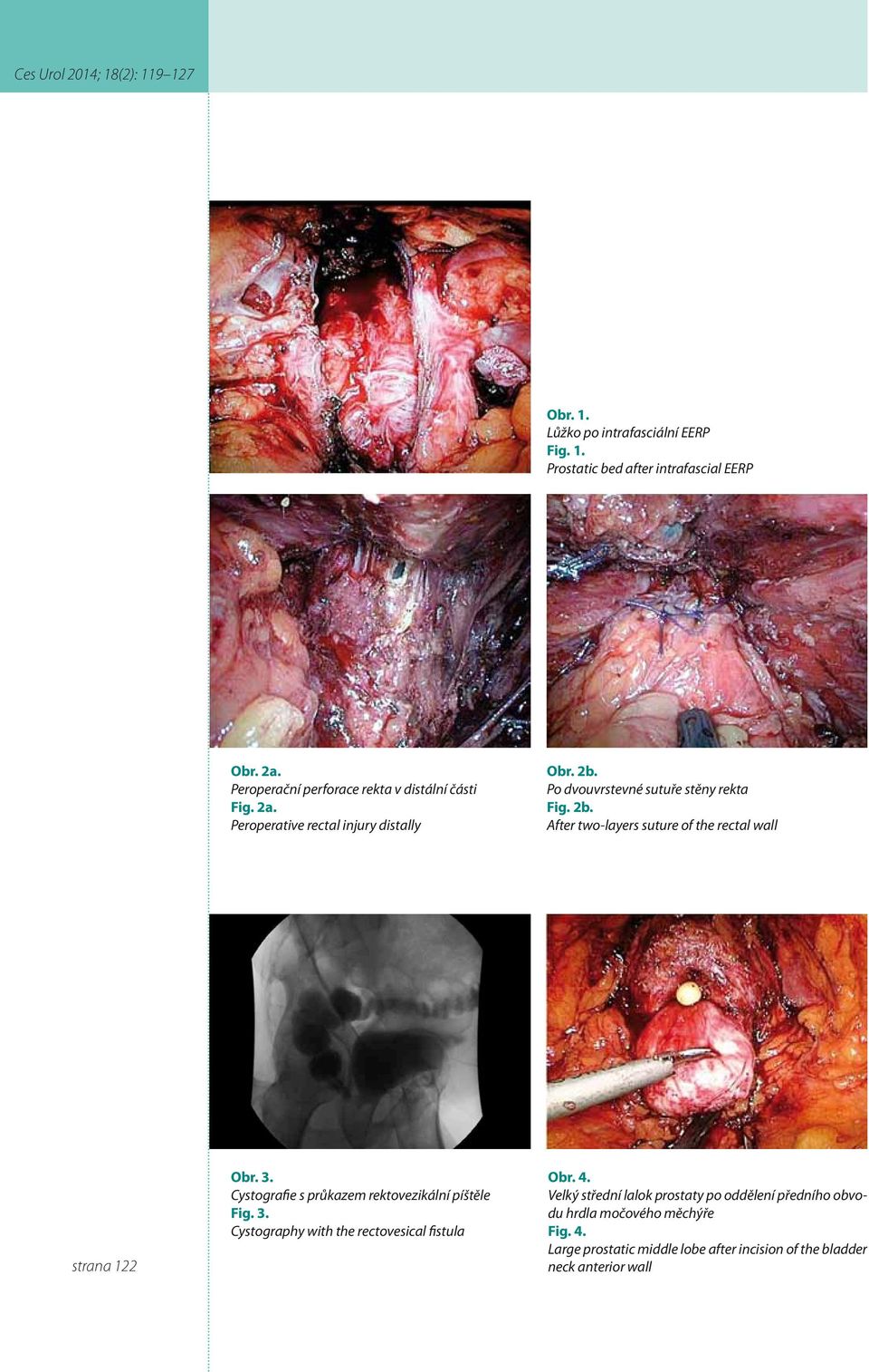 3. Cystografie s průkazem rektovezikální píštěle Fig. 3. Cystography with the rectovesical fistula Obr. 4.