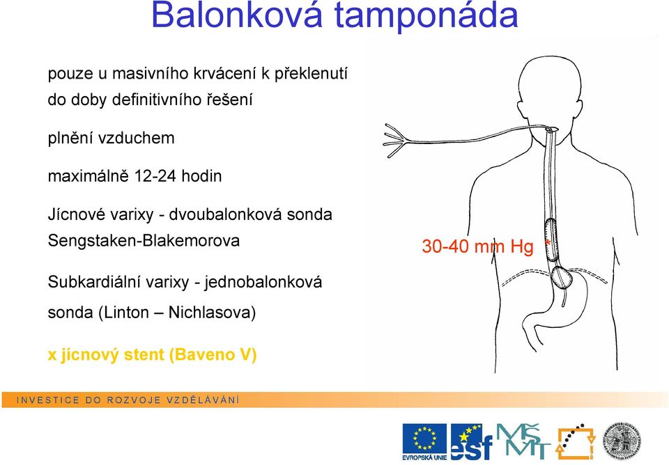 varixy - dvoubalonková sonda Sengstaken-Blakemorova 30-40 mm Hg *