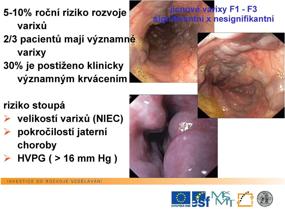 varixy F1 - F3 signifikantní x nesignifikantní riziko stoupá