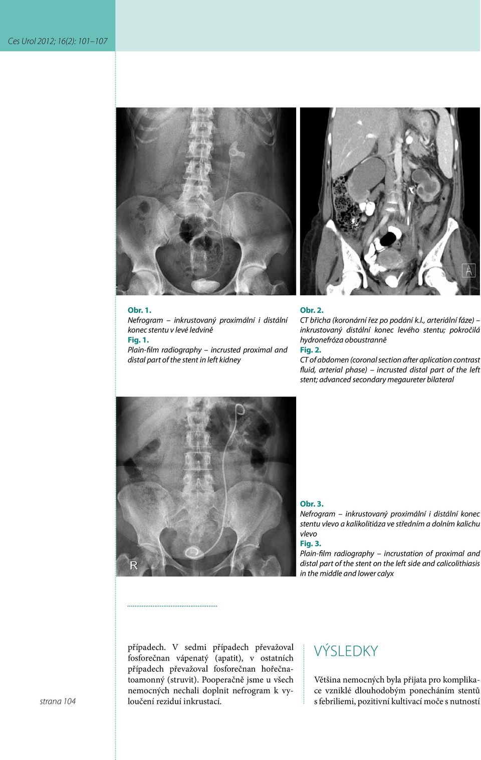 CT of abdomen (coronal section after aplication contrast fluid, arterial phase) incrusted distal part of the left stent; advanced secondary megaureter bilateral Obr. 3.