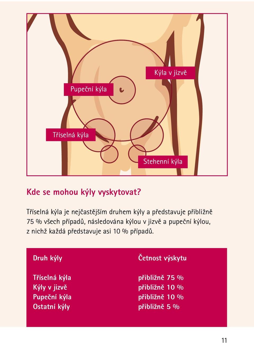 kýlou v jizvě a pupeční kýlou, z nichž každá představuje asi 10 % případů.