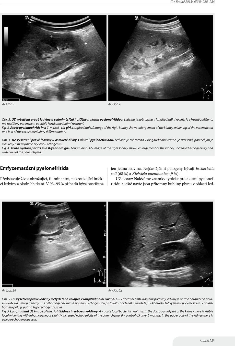 Longitudinal US image of the right kidney shows enlargement of the kidney, widening of the parenchyma and loss of the corticomedullary differentiation. Obr. 4.