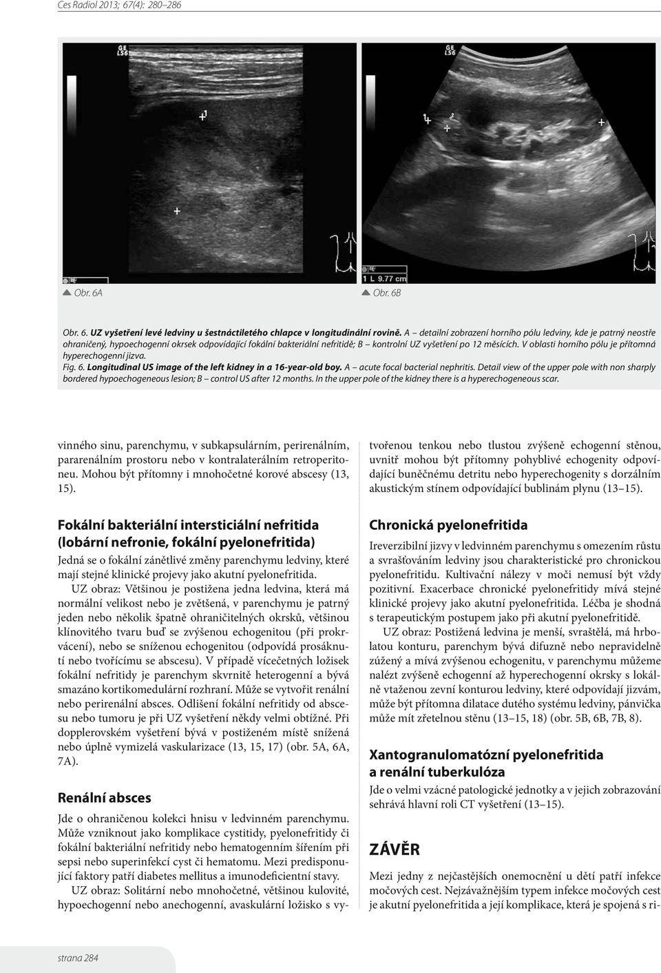 V oblasti horního pólu je přítomná hyperechogenní jizva. Fig. 6. Longitudinal US image of the left kidney in a 16-year-old boy. A acute focal bacterial nephritis.