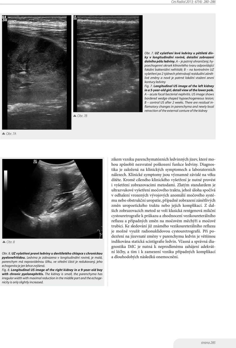 patrné lokální vtažení zevní kontury ledviny Fig. 7. Longitudinal US image of the left kidney in a 5-year-old girl, detail view of the lower pole. A acute focal bacterial nephritis.