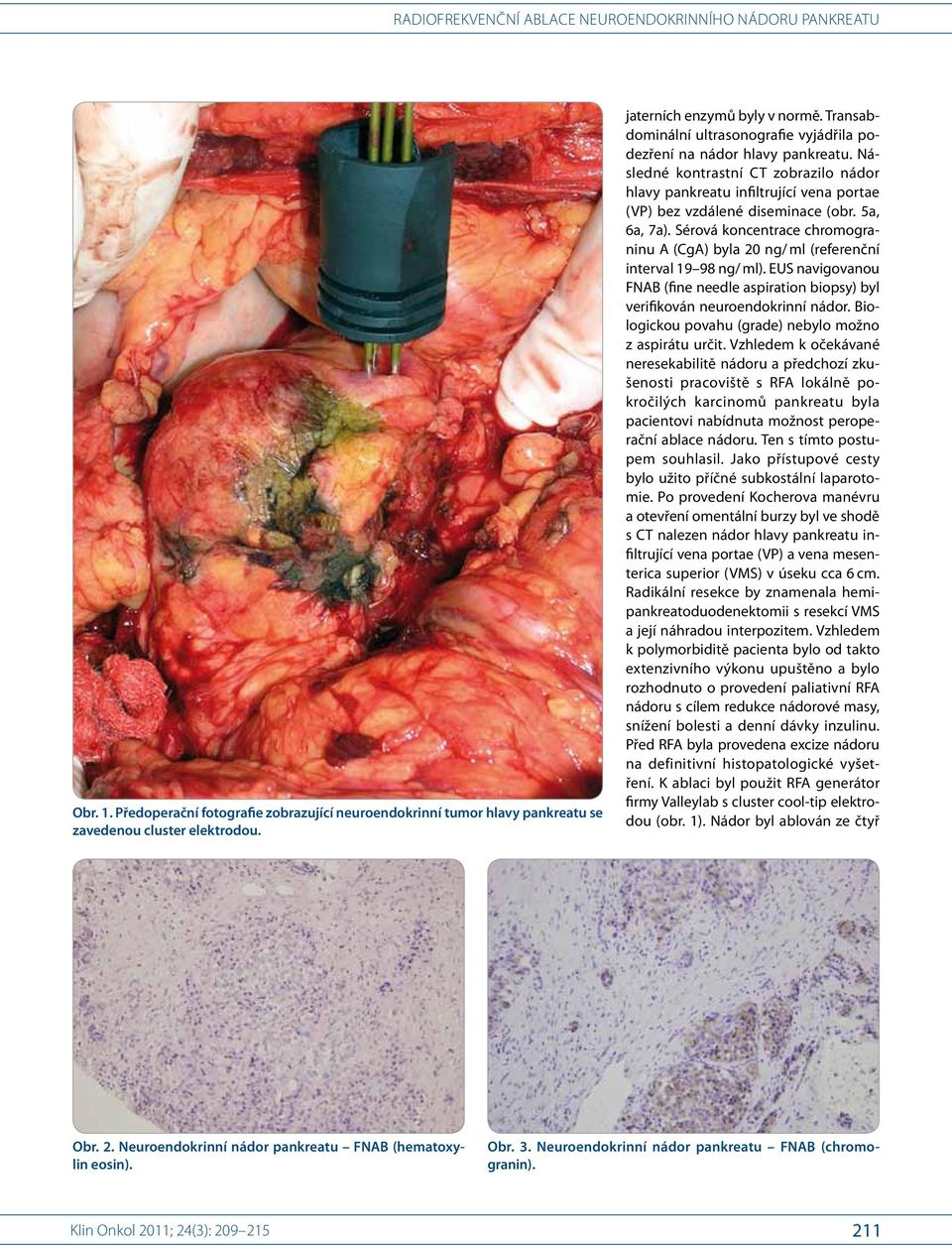 5a, 6a, 7a). Sérová koncentrace chromograninu A (CgA) byla 20 ng/ ml (referenční interval 19 98 ng/ ml). EUS navigovanou FNAB (fine needle aspiration biopsy) byl verifikován neuroendokrinní nádor.