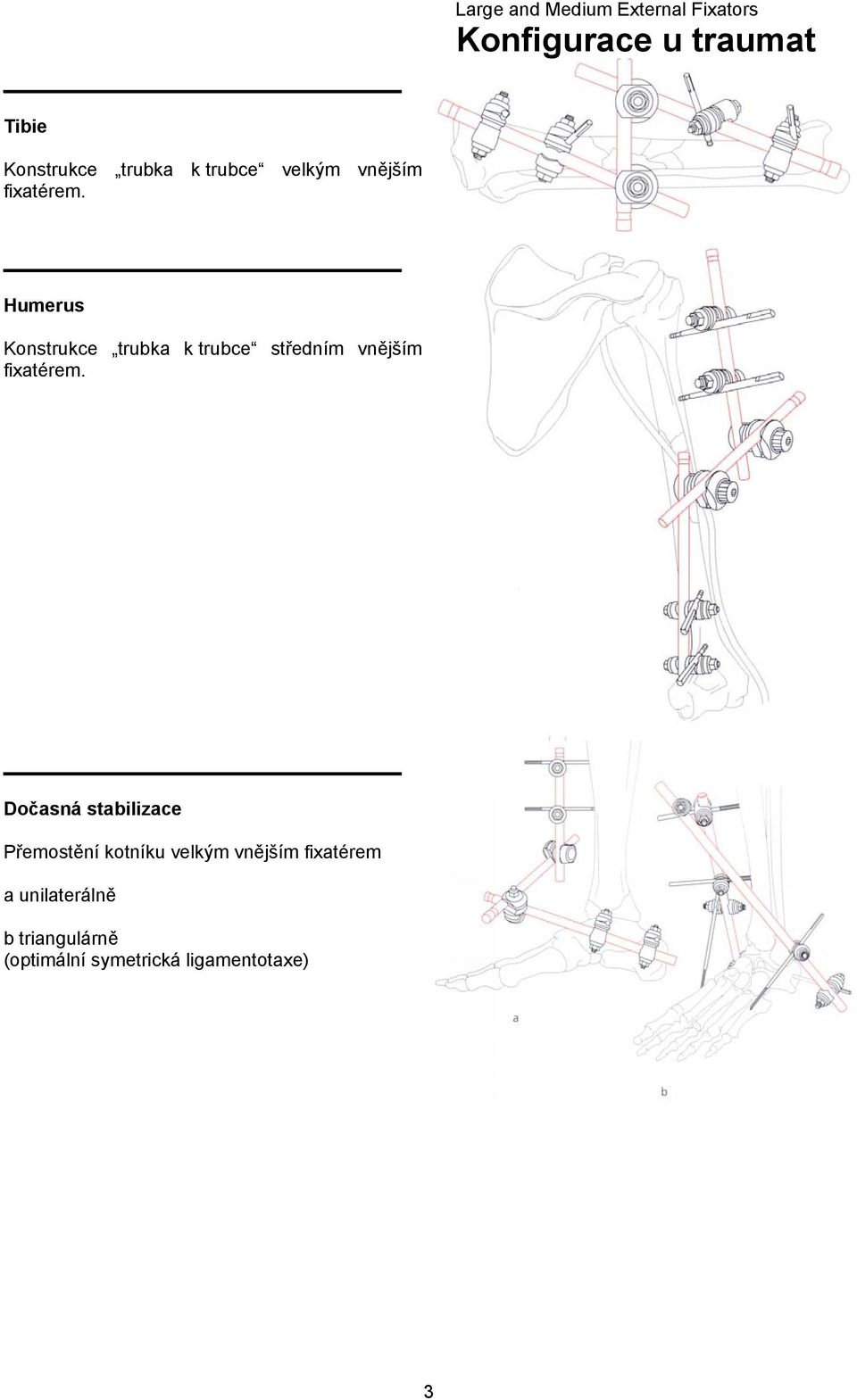 Humerus Konstrukce trubka k trubce středním vnějším fixatérem.