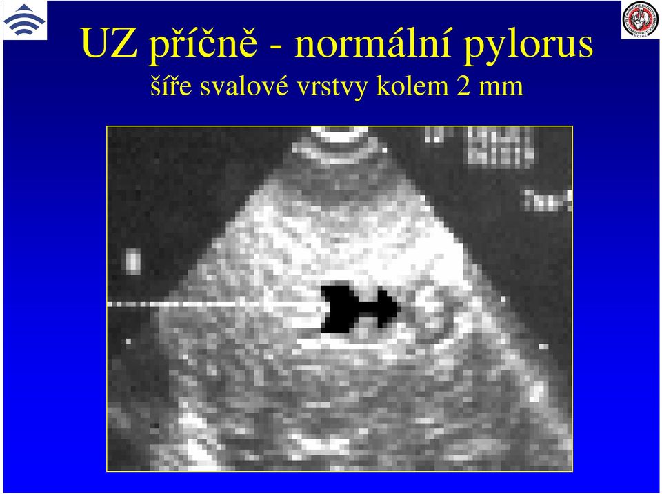 pylorus šíře