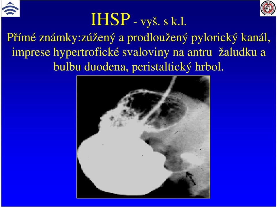 pylorický kanál, imprese hypertrofické