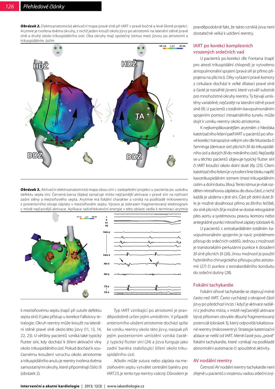 Oba okruhy mají společný istmus mezi jizvou po atriotomii a trikuspidálním ústím Obrázek 3. Aktivační elektroanatomická mapa obou síní v zadopřední projekci u pacienta po uzávěru defektu septa síní.