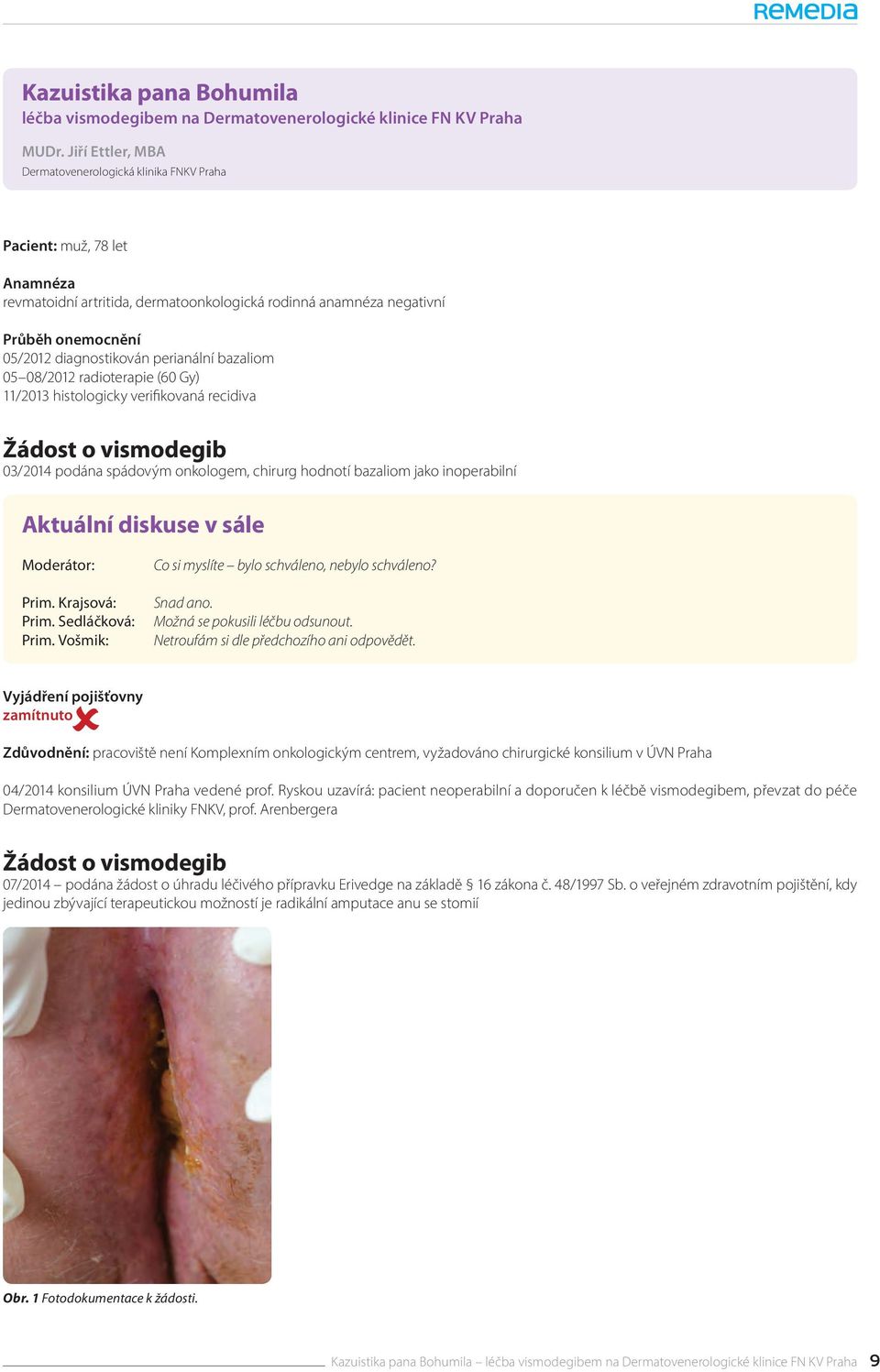 perianální bazaliom 05 08/2012 radioterapie (60 Gy) 11/2013 histologicky verifikovaná recidiva Žádost o vismodegib 03/2014 podána spádovým onkologem, chirurg hodnotí bazaliom jako inoperabilní